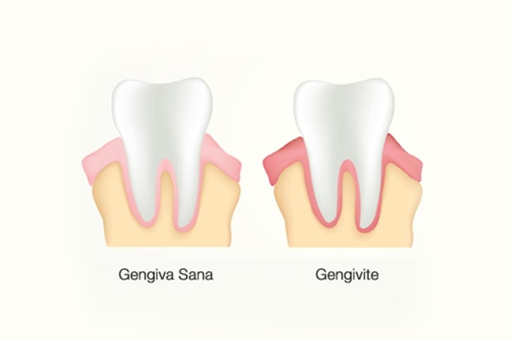 Differenza tra gengiva sana e gengivite