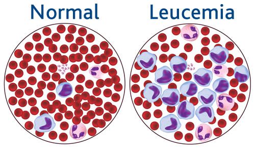 Differenza tra sangue normale e sangue di un paziente con la leucemia linfoblastica acuta