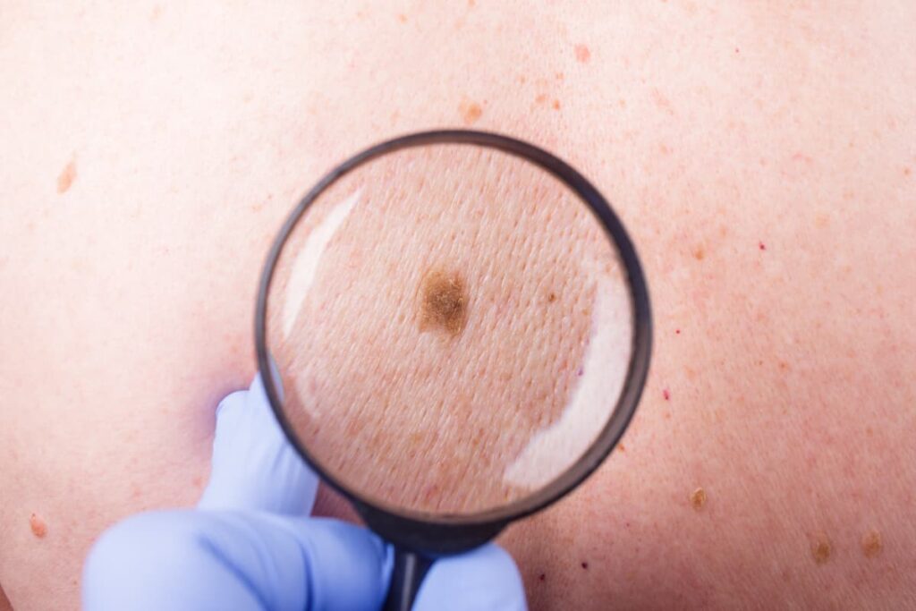 Melanoma IA