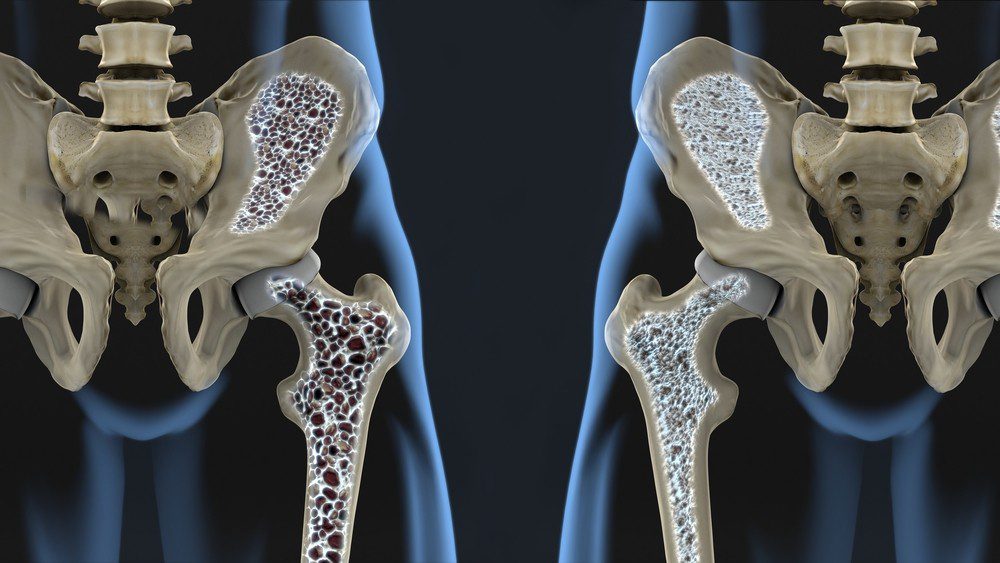 ossa prevenire osteoporosi