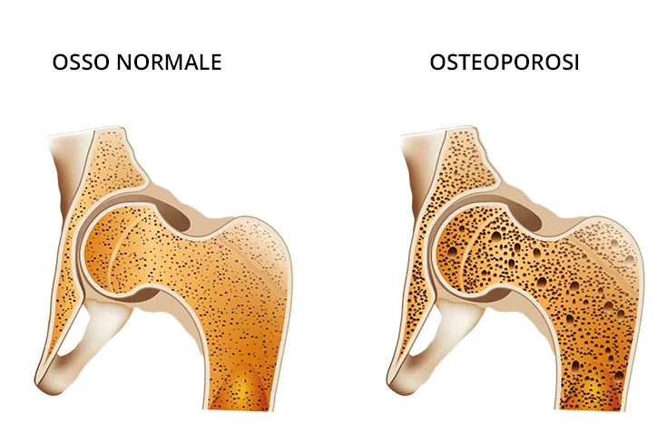 La prevenzione dell'osteoporosi è fondamentale. In questa immagine un'osso normale ed un osso affetto da questa patologia