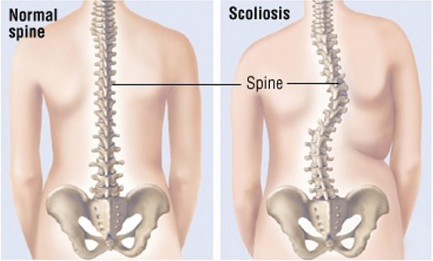 Differenza tra colonna vertebrale normale e con scoliosi.