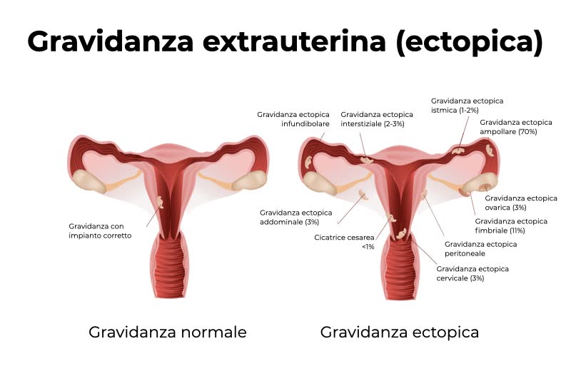 Differenti tipologie di gravidanza Ectopica