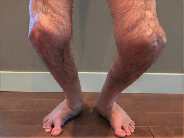 Sindrome di Larsen