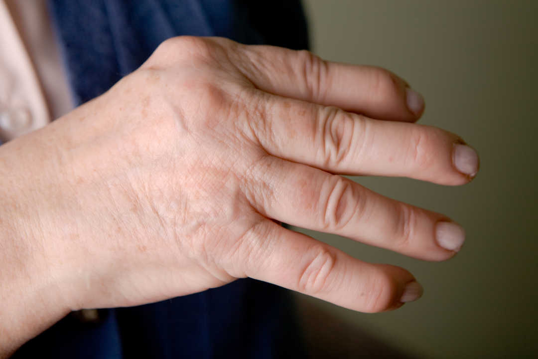 Artrite Psoriasica