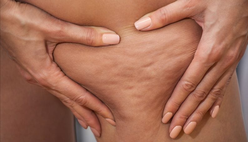 Buccia d'arancia sulle gambe