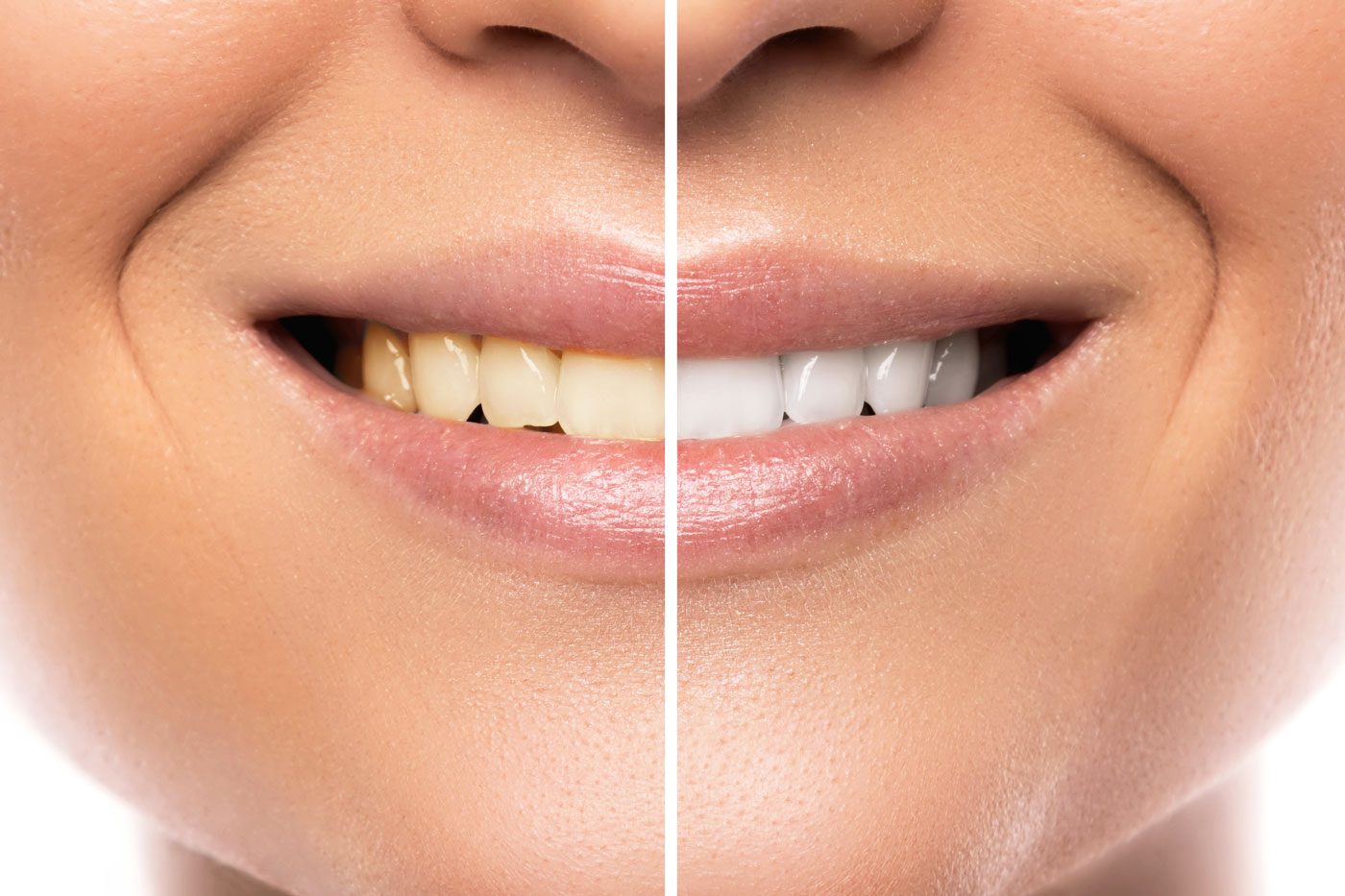 sbiancare i denti con il bicarbonato