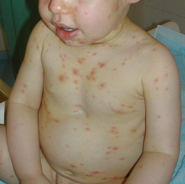 Malattie della pelle nei bambini