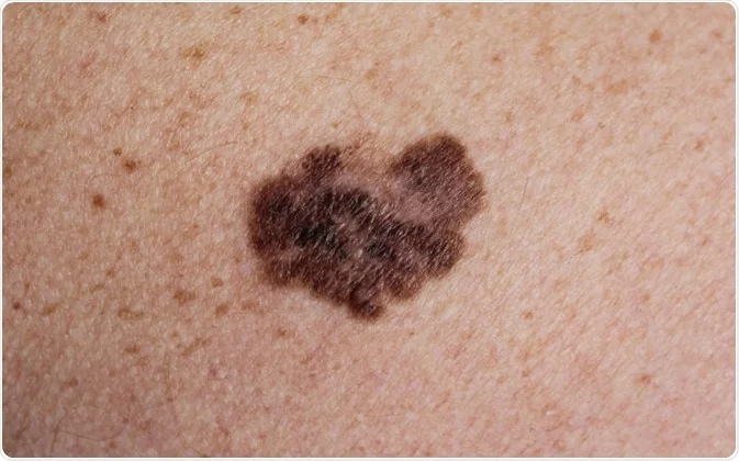 Melanoma Negli Under 50