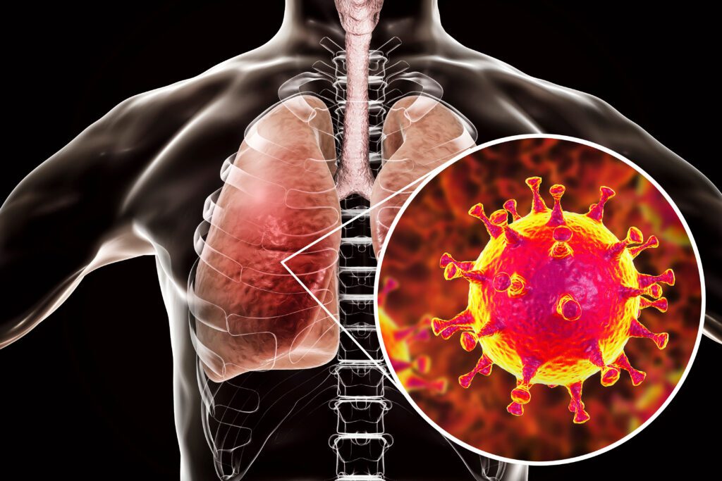 Mers un nuovo caso di coronavirus