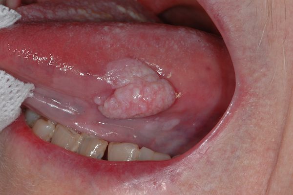 Tumore alla bocca