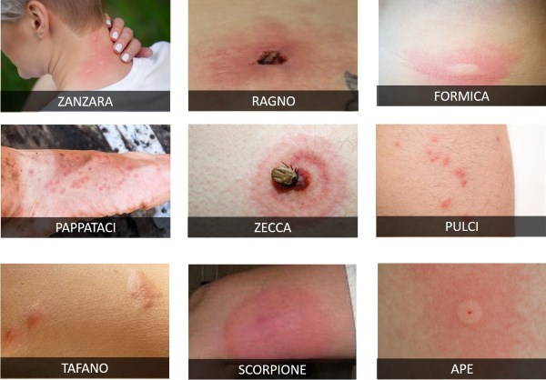 Punture di insetti cosa fare