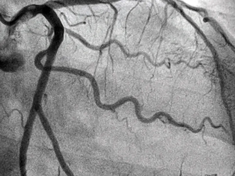 angiografia