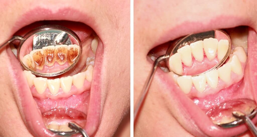Tartaro dentale