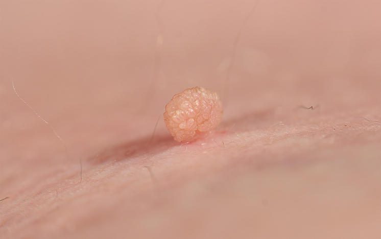 Fibroma Pendulo