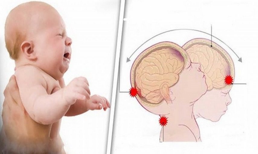 Shaken Baby Syndrome in Italia