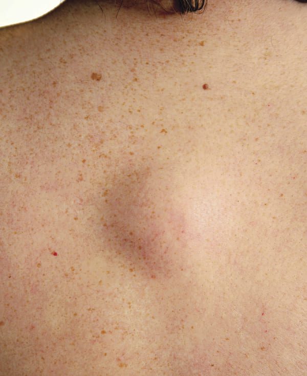 L'Asportazione delle Cisti Sebacee