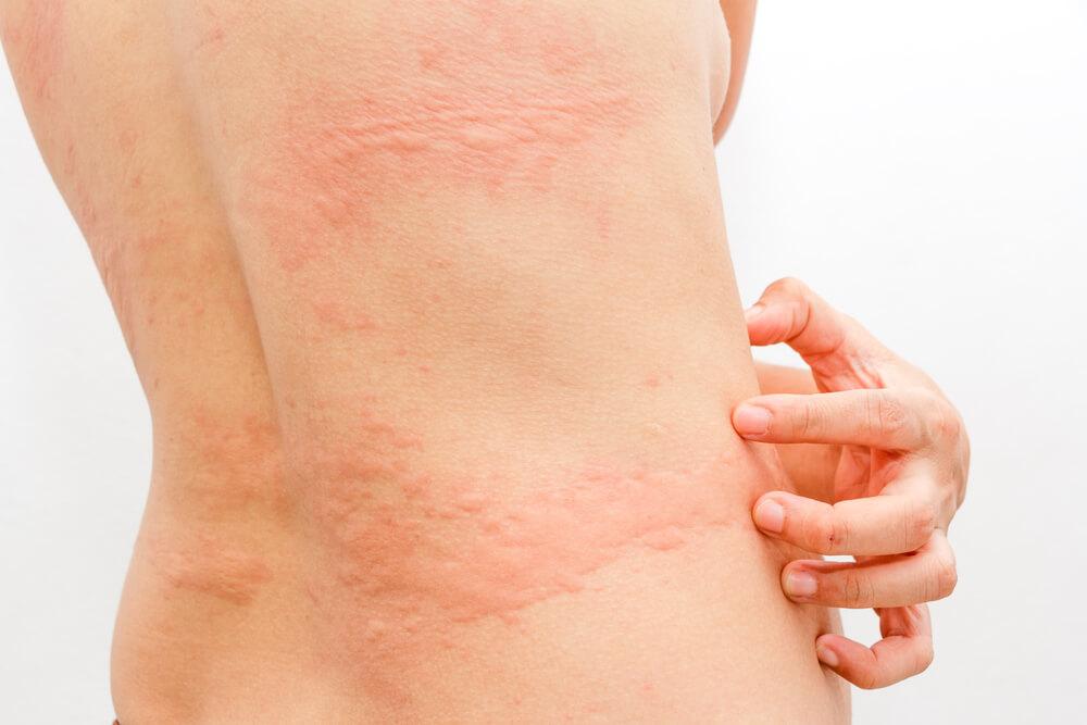 Urticaria eruzione cutanea