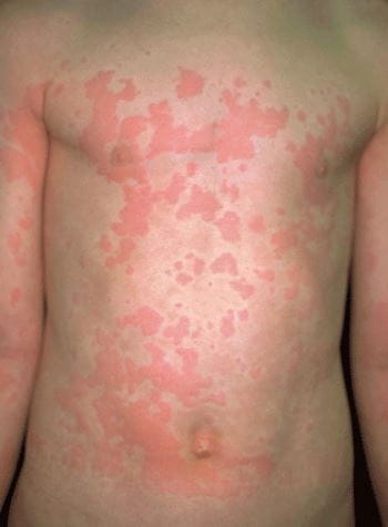 Reazioni Cutanee ai Farmaci allergie