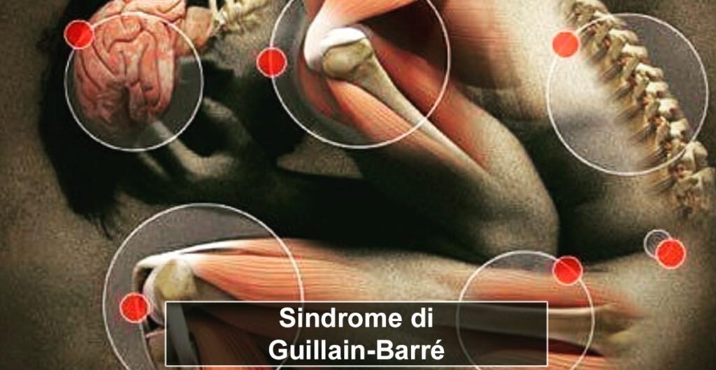 Affrontare la Sindrome di Guillain-Barré