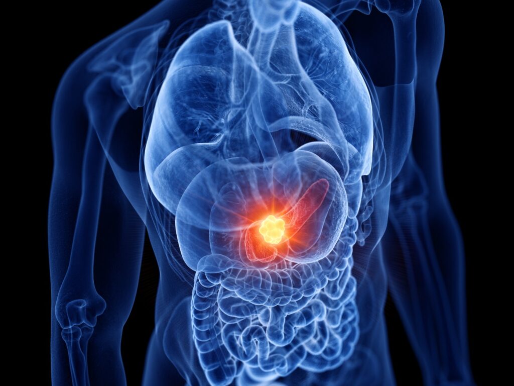 Tumori Neuroendocrini cause