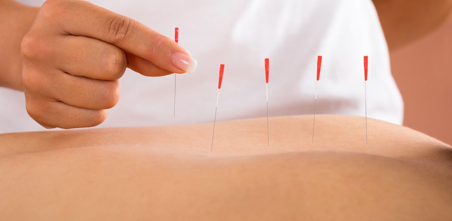 Agopuntura e Medicina Naturale