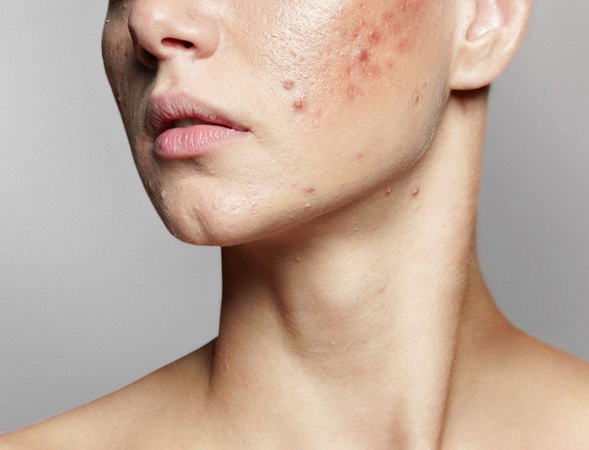 Come Trattare Acne in Età Adulta