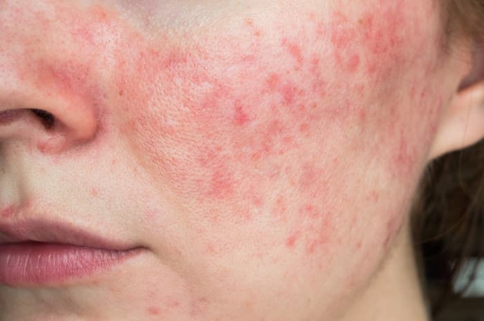 Cosa c'è da sapere sulla Rosacea