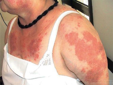 Lupus Eritematoso Sistemico