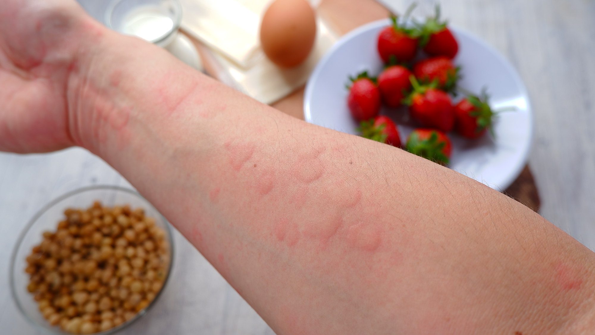 Sintomi delle Allergie Alimentari Riconoscere e Affrontare — free download