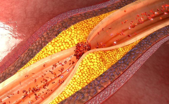Il Ruolo dei Trigliceridi nelle Malattie Cardiache