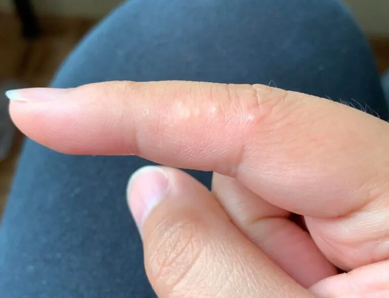 Eczema Disidrosico