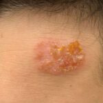 Impetigine infezione