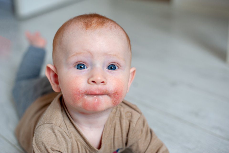 I Rischi delle Allergie Alimentari nei Bambini