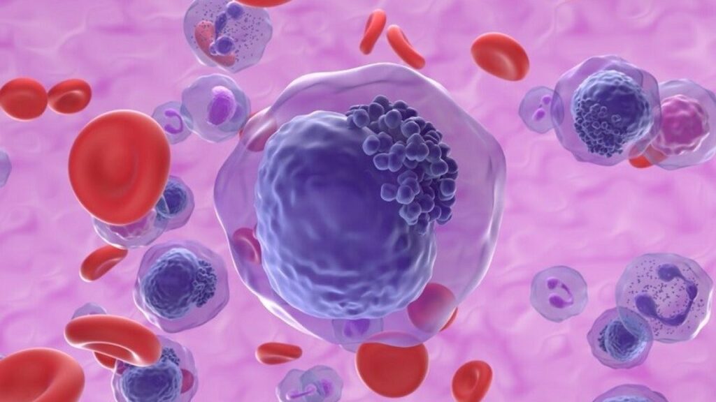 La Leucemia Mielomonocitica Cronica