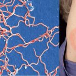 La Borrelia burgdorferi