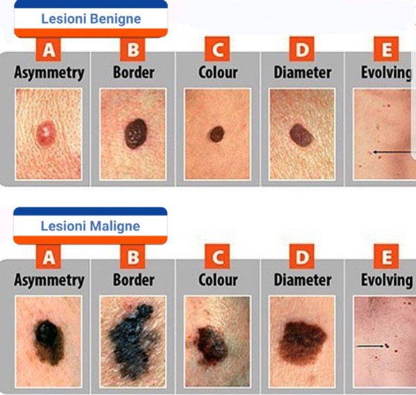 Nevo o Melanoma