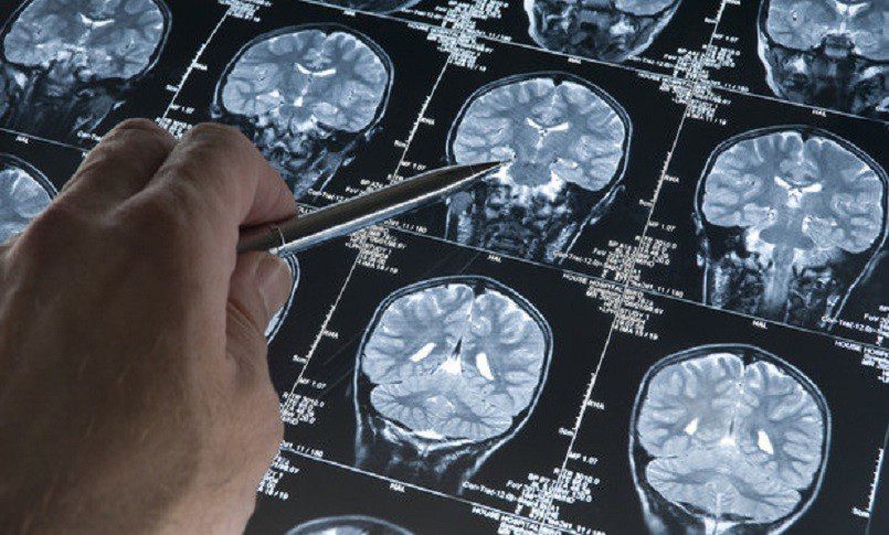 Diagnosi dei Tumori Cerebrali: Imaging e Biopsia