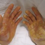 Cheratoderma Palmoplantare