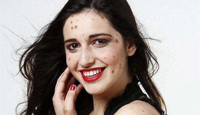 donna con tanti nei sul viso