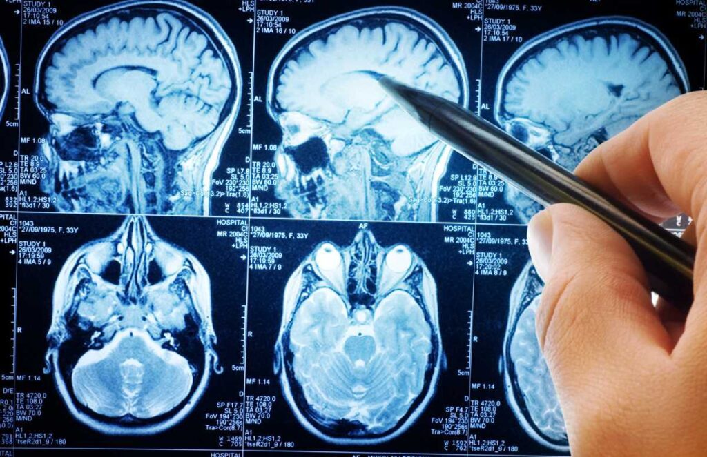 Innovazioni nella Diagnosi dei Tumori Cerebrali