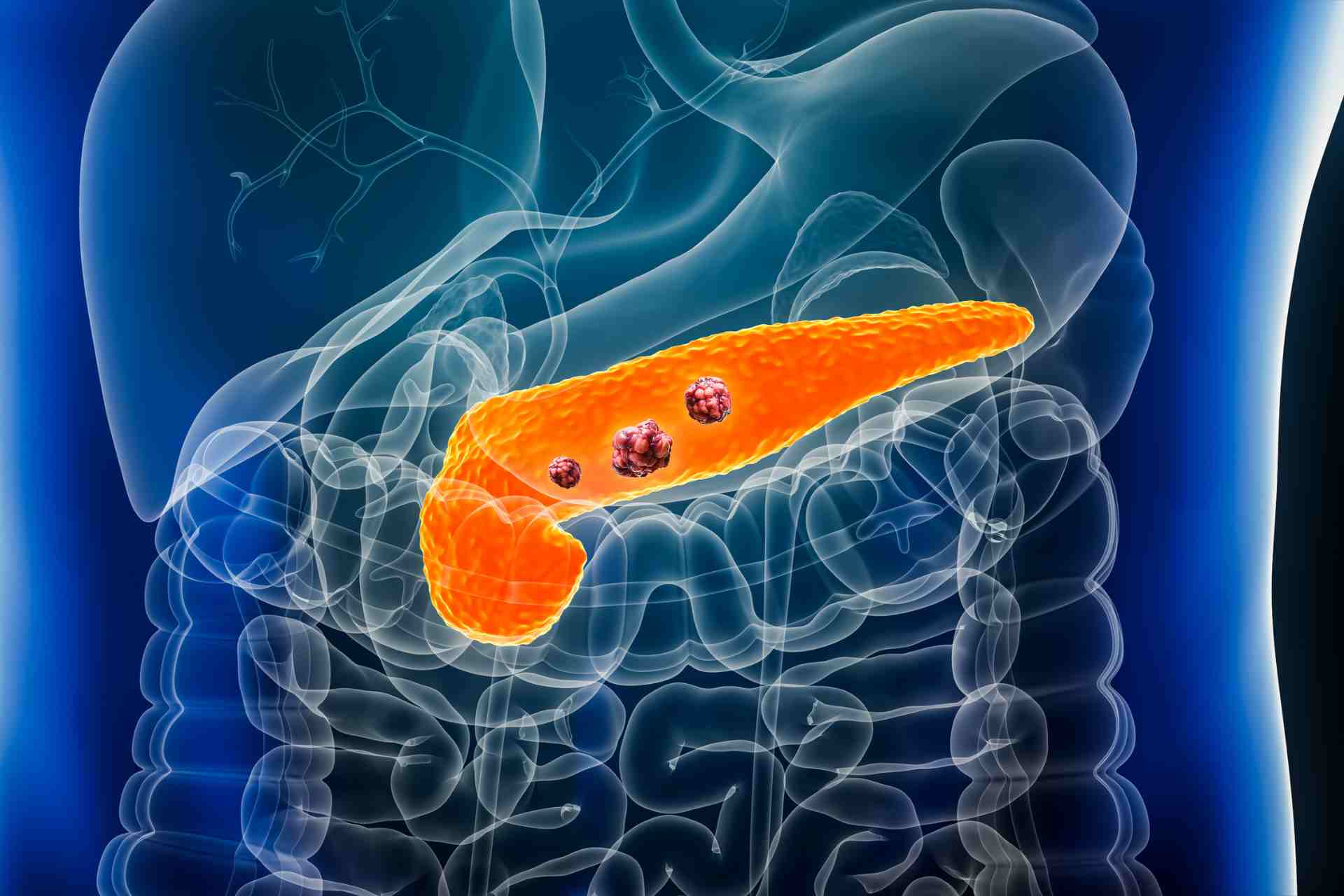 Diagnosi Precoce del Tumore al Pancreas