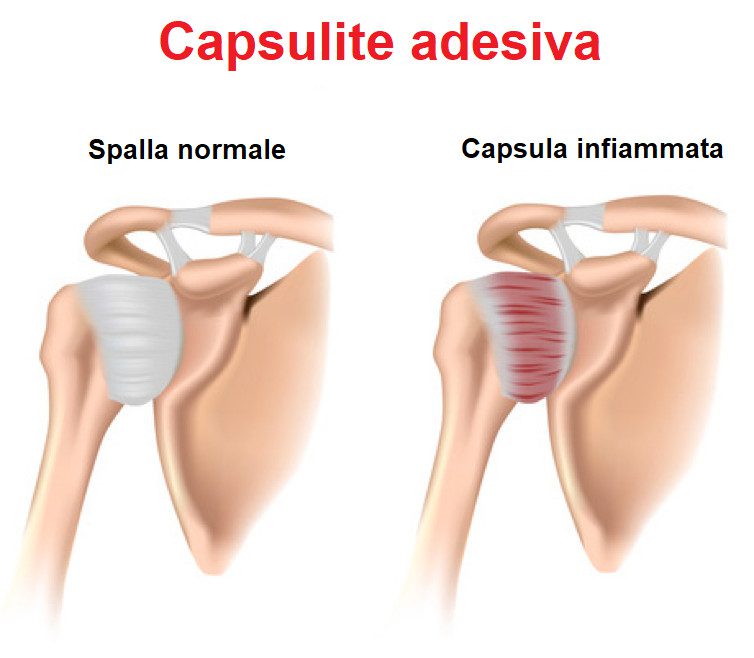 Capsulite Adesiva