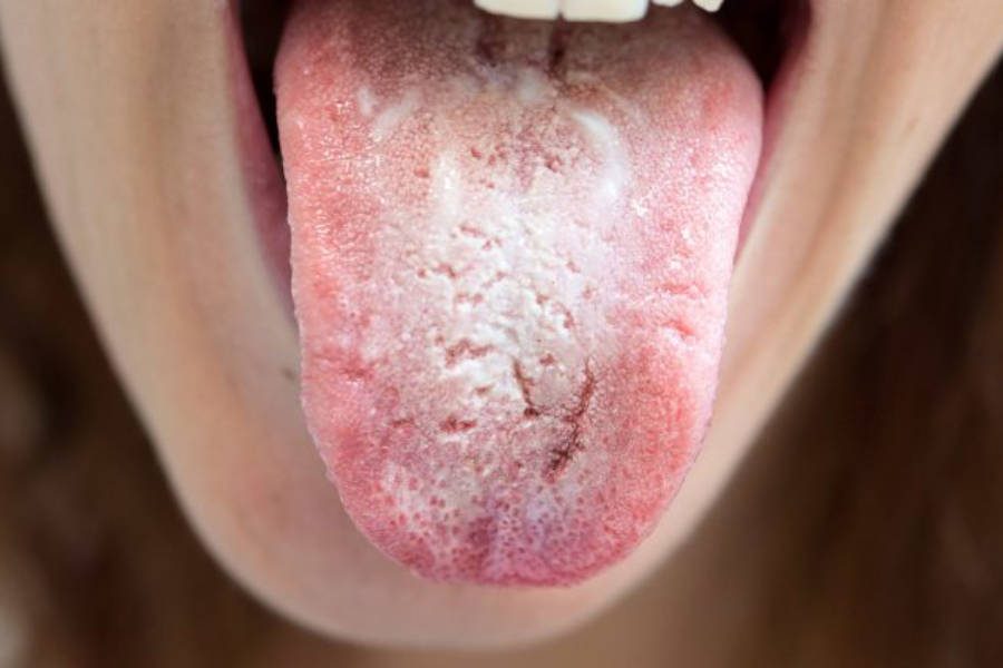 Microrganismi che producono tossine nelle micosi: micosi orale, chiamata anche mughetto