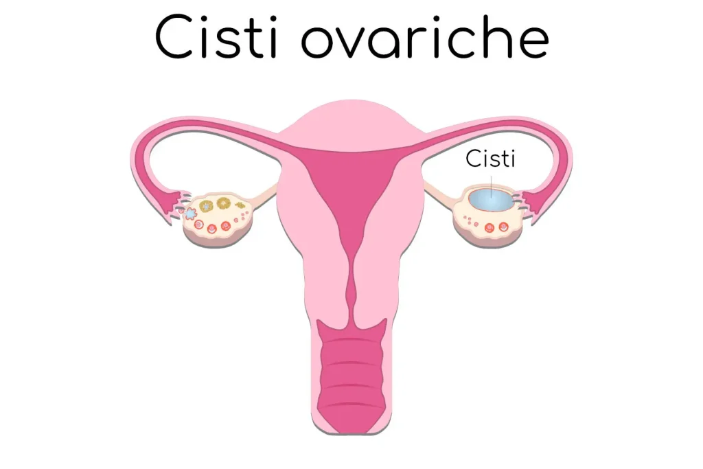 Chirurgia per la Correzione delle Cisti Ovariche