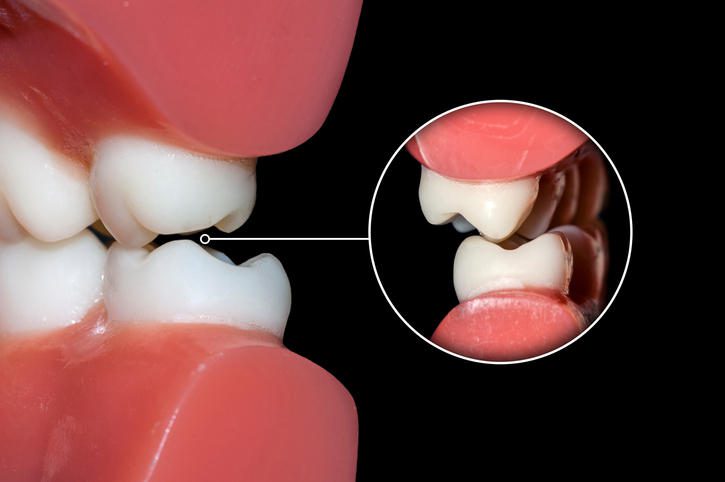 Malocclusione Dentale Cause