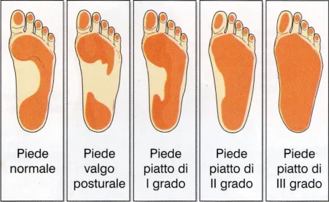 Piede Piatto