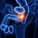 Tumore alla Prostata Diagnosi