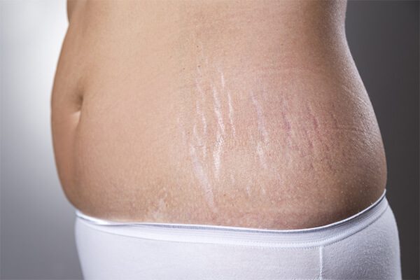 Come prevenire e trattare le smagliature