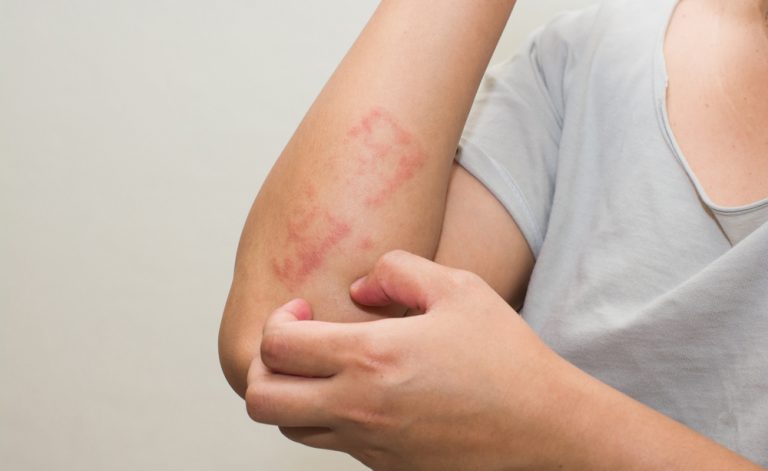 La Allergie Cutanee negli Anziani